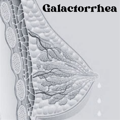 is galactorrhea safe to drink|Galactorrhea: Causes, Symptoms & Treatment